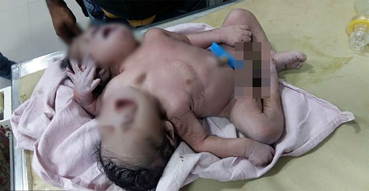 ¡Insólito! Nace bebé con dos cabezas y tres brazos en la India