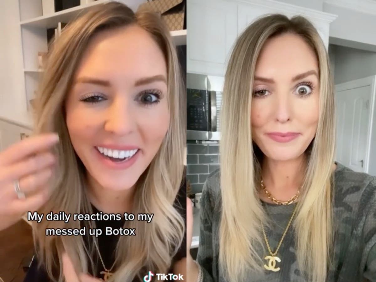 Influencer puts botox on her face and is left with a droopy eyelid